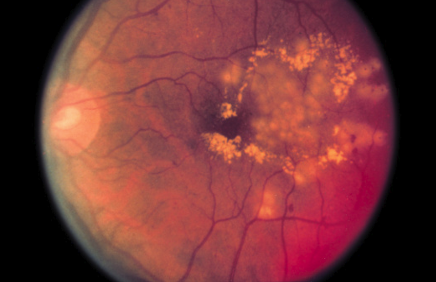 Diabetic Retinopathy: cause, symptoms and treatment