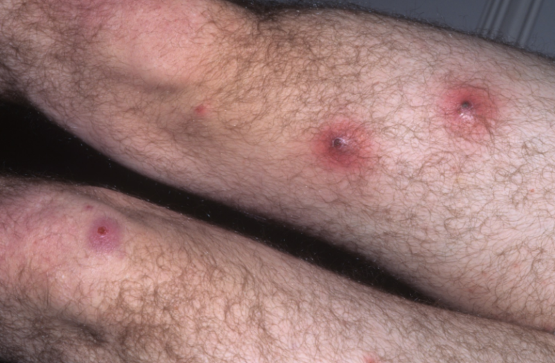 जानिए क्यों होती है बालतोड़ की समस्या