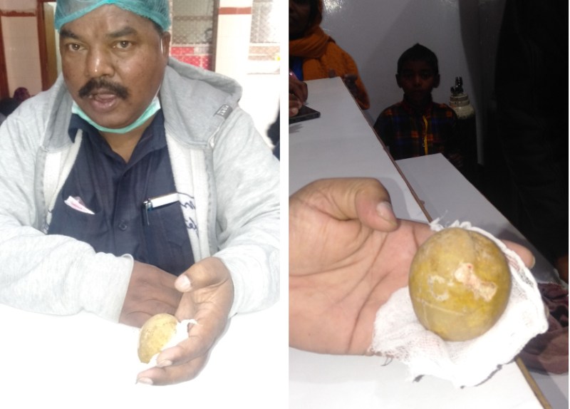 16 वर्षीय लडक़ी के पेट में रहता था दर्द, घरवाले अस्पताल ले गए तो ये देखकर डॉक्टर भी रह गए हैरान