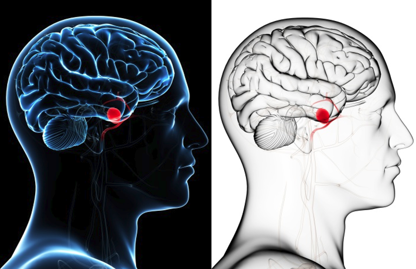 Cerebral Aneurysm: causes, symptoms and treatment