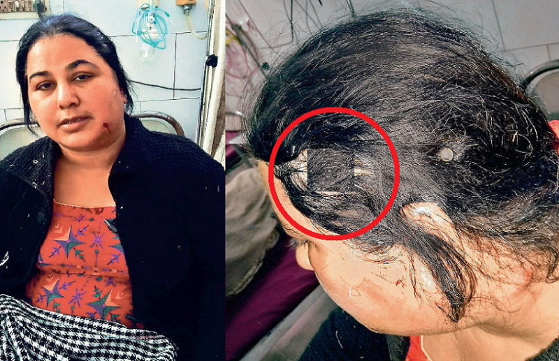 3 bullets hit the head and one in jaw but woman reached the hospital after driving 28 km