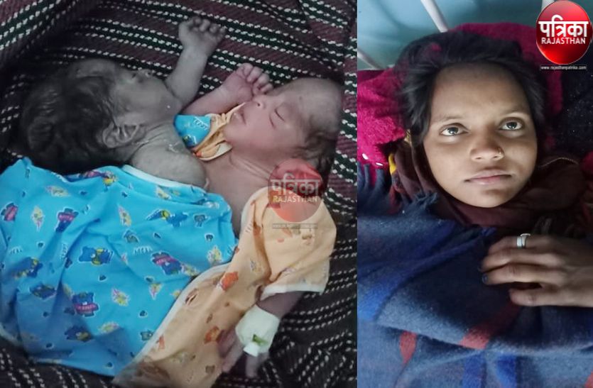बाली में दो मुहं के विचित्र बच्चे का जन्म, एम्स में किया रैफर