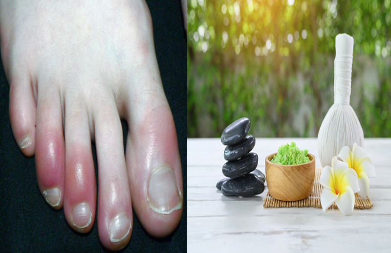 Home Remedies to Treat Chilblains Disease