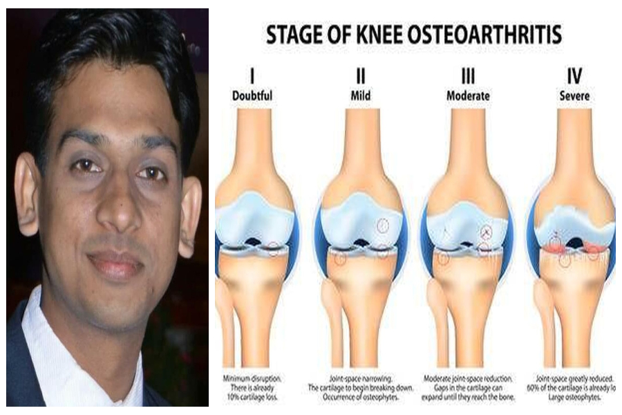 jodhpur's doctor research on knee replacement operation