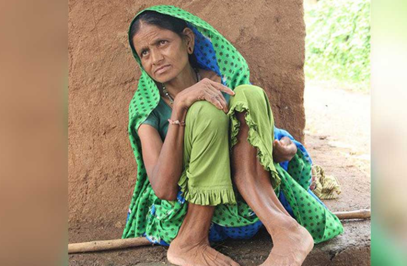 यूपी मेें जहां सोना मिलने की बात हो रही, वहां के लोग फ्लोरोसिस बीमारी से पीड़ित