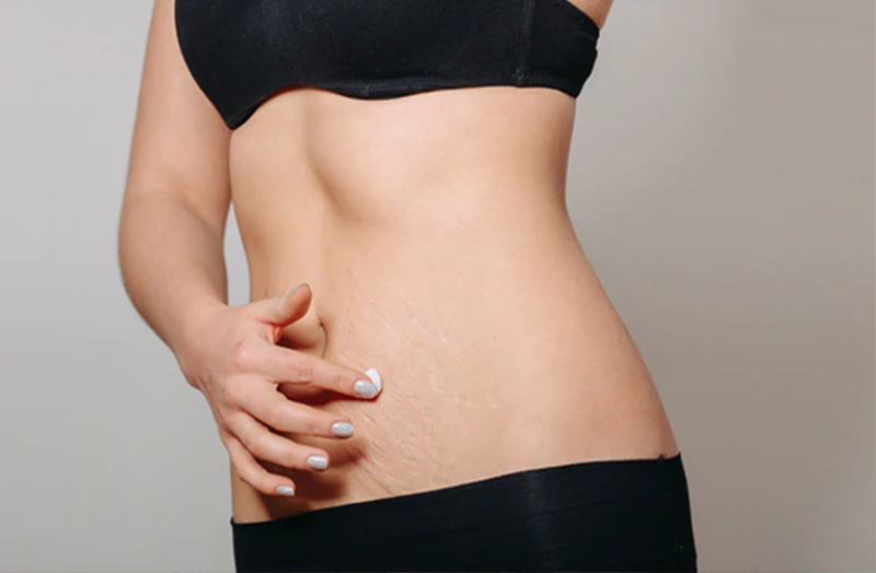 मेकअप से ऐसे ढकें स्ट्रेच मार्क्स , जानें ये खास टिप्स