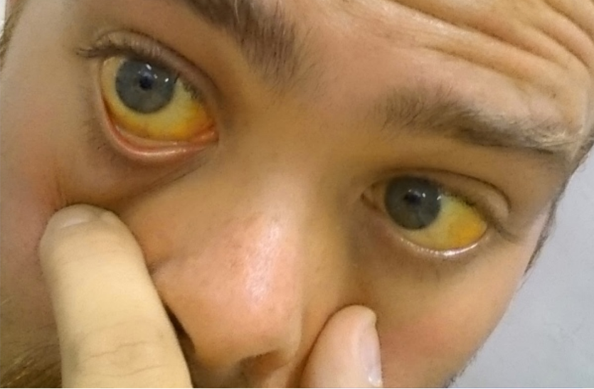 पीलिया के रोगियों को जरूर जाननी चाहिए ये खास बातें