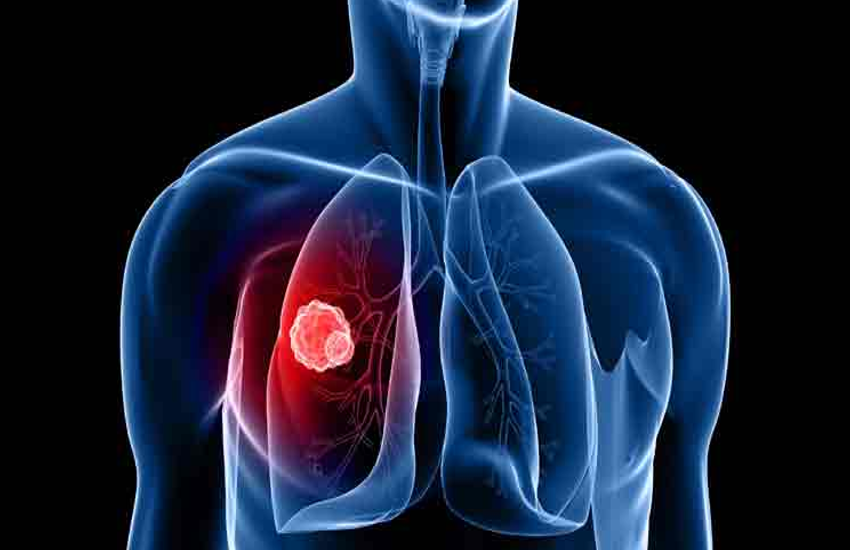 Respiratory Diseases: Causes, symptoms and Risk Factor