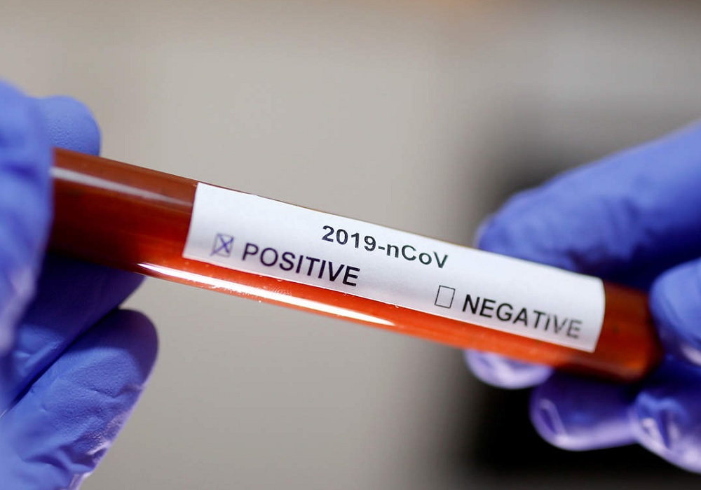 बड़ी राहतः तीन कोराना वायरस पाजिटिव मरीजों का दूसरा सेंपल निगेटिव, अब तीसरे का इंतजार