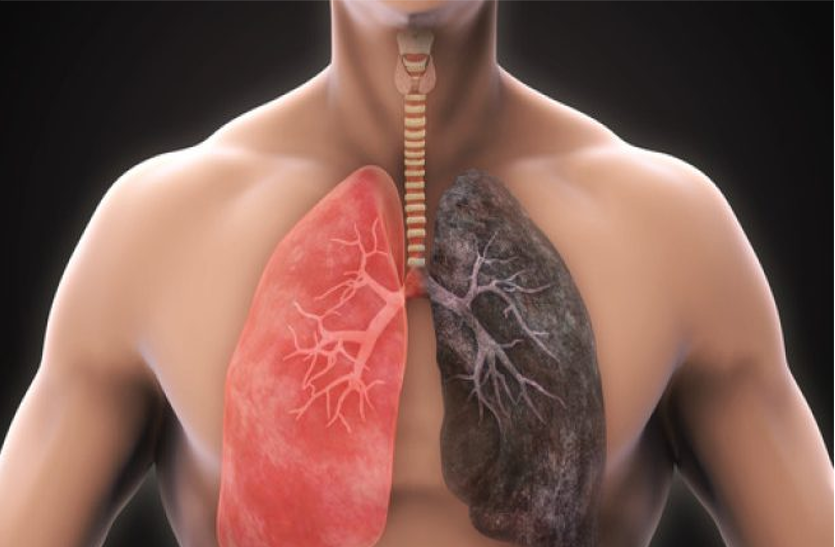 Covid-19 : एक साल पहले अमेरिका में श्वास तंत्र की घातक बीमारी फैली थी