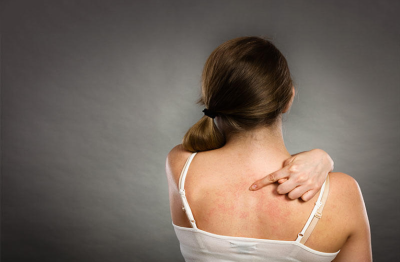 गर्मी में पसीने और घमौरियों से एेसे पाए छुटकारा, अपनाएं ये आसान उपाय