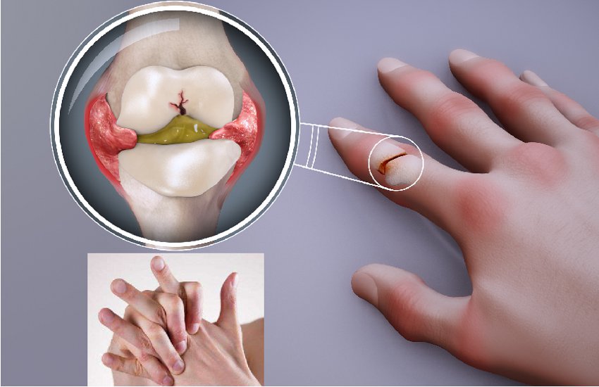 अगर आप उंगलियां चटकाते है तो छोड़े दे ये खतरनाक आदत, हड्डियों में हो सकती है गंभीर नुकसान