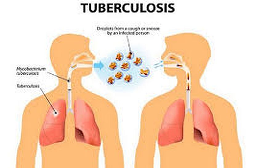 TB will be cured in six months instead of two years in bhilwara