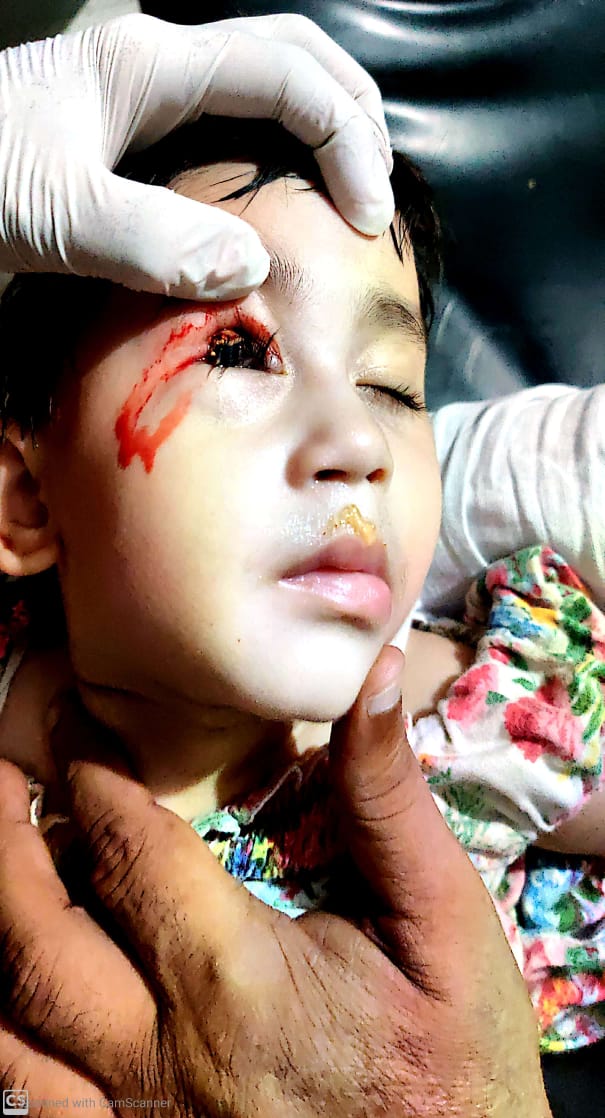 Two-inch pencil penetrates two-year-old girl's eye