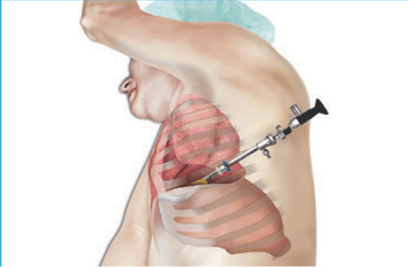 फेफड़ों में पानी भरने की समस्या के लिए इस तरह से करते हैं उपचार