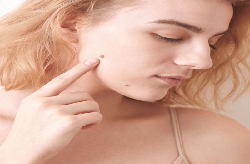 इन घरेलू नुस्खों से हटाएं शरीर के अनचाहे मस्से