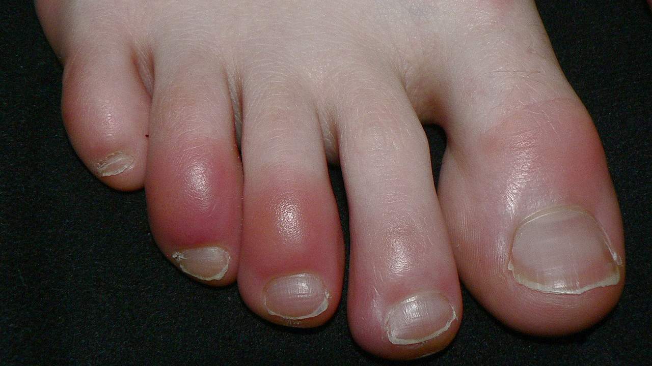 कोरोना का नया लक्षण- पैर में दिखें नीले अथवा लाल रंग के निशान तो सावधान, हो सकता है 'कोविड-टो'