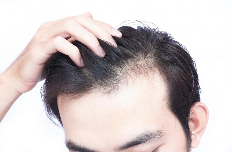 HAIRFALL PROBLEM : बारिश के दिनों में बालों को झडऩे से कैसे रोकें?