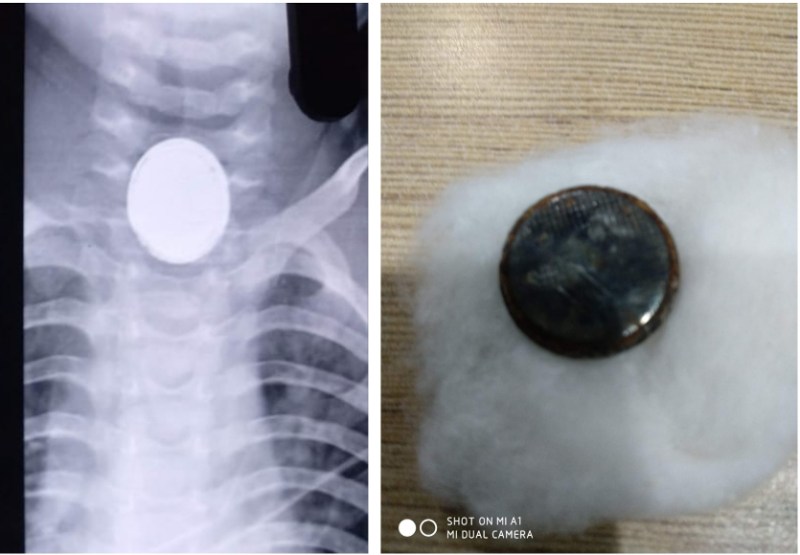 खेल-खेल में सिक्के की तरह दिखने वाला बैट्री के पीछे का हिस्सा निगल गया मासूम, माता-पिता के लिए डॉक्टर बने भगवान