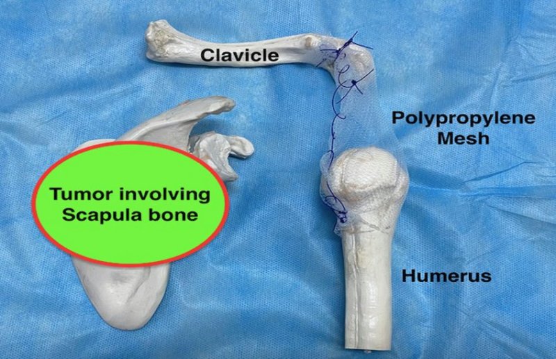 GCRI : कंधे की हड्डी को अलग-थलग कर किया कैंसर मुक्त