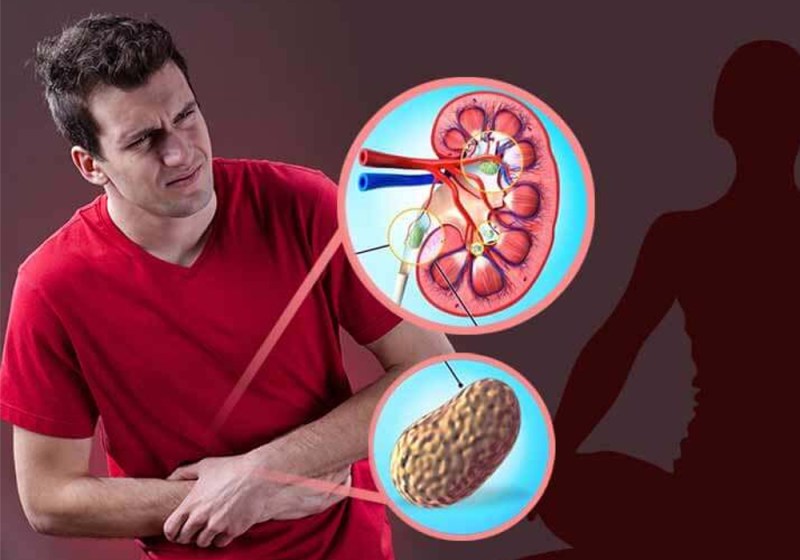 kidney stone medicine