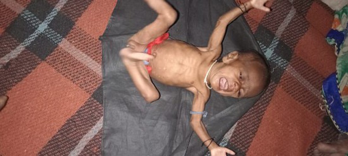 irresponsibility: malnutrition death in shahdol madhya pradesh