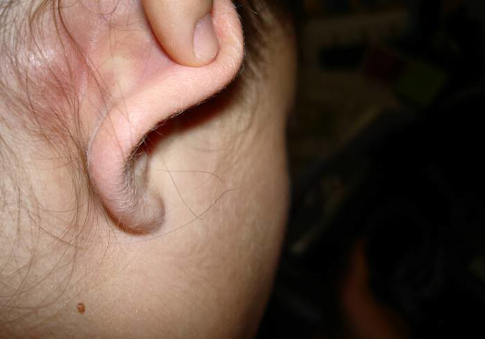 केजीएमयू में अनोखी सर्जरी, हाथ पर कान बनाकर किया इंप्लांट, फिर छह माह बाद चेहरे पर लगाकर लौटाई सुंदरता