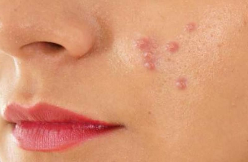 बेसन और कपूर से दूर होंगे कील मुंहासे, निखरेगी चेहरे की रंगत.....