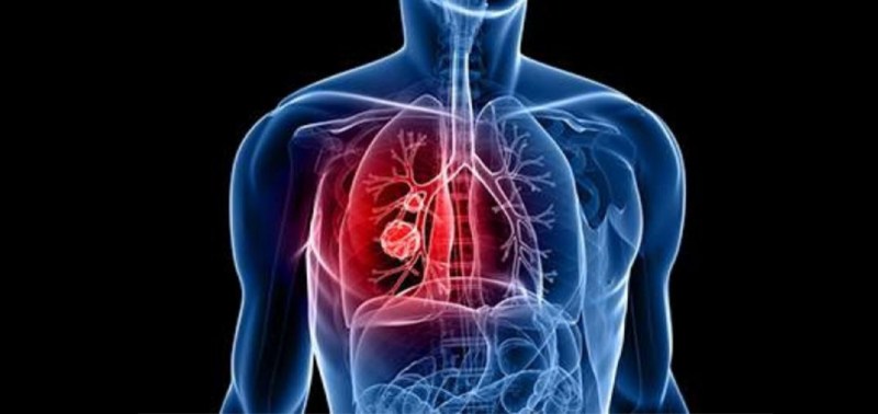 फेफड़ों की टीबी जरा सी लापरवाही से लेती है चपेट में