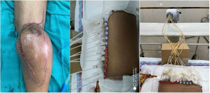 पैर में कैंसर की गांठ को सर्जरी से निकाला