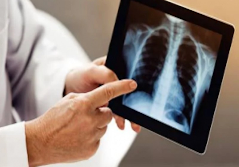 फेफड़ों को प्रभावित कर रहा है कोरोना वायरस, कार्बन डाइऑक्साइड भरने से हो रहा नुकसान, जानें गंभर लक्षण