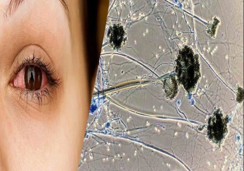 Guidelines for Black Fungus