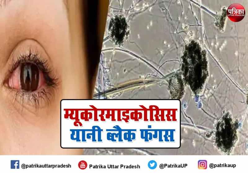 mucormycosis black fungus symptoms and treatment