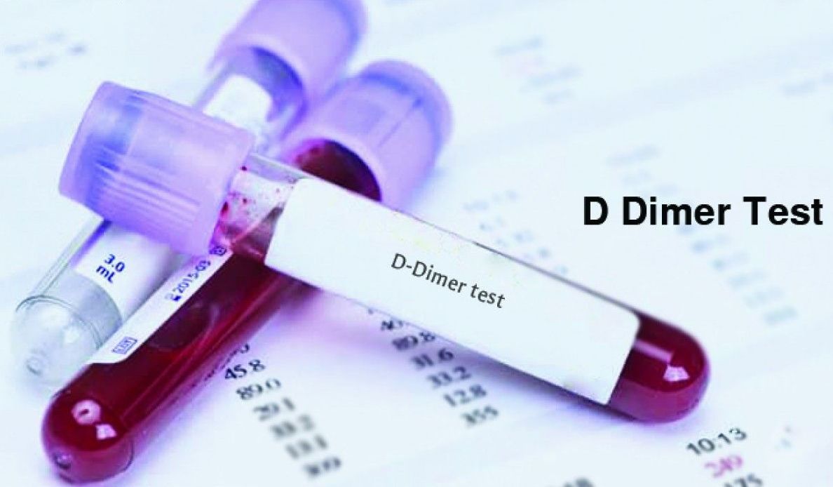 बिना लक्षण के कोरोना मरीज़ों के लिए है डी-डाइमर टेस्ट