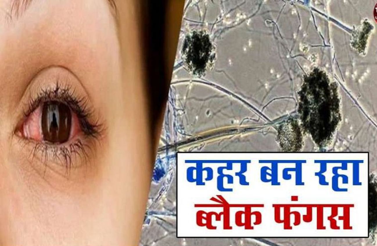 ब्लैक फंगस से जोधपुर में पहली मौत, सफल ऑपरेशन के बाद मरीज को पड़ा दौरा