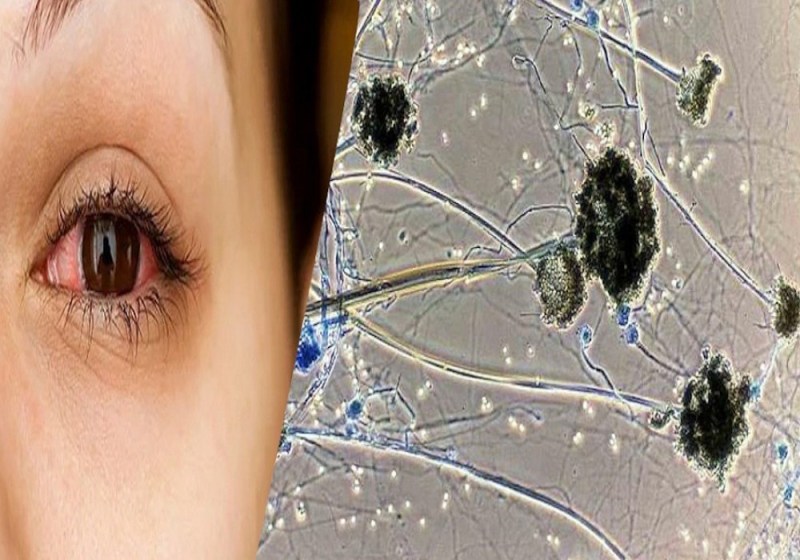 Three dead due to Black Fungus in Varanasi