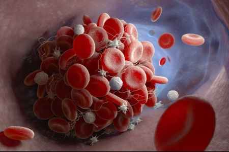 blood_clot.jpg