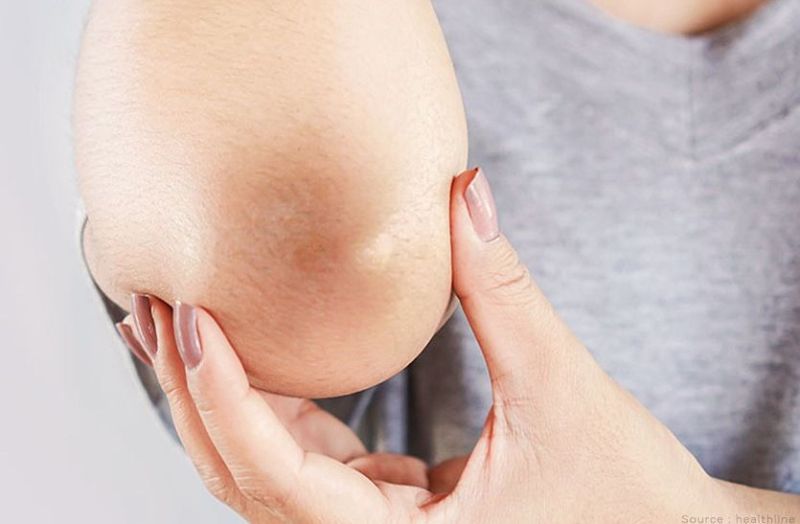 Blackness of knees and elbows