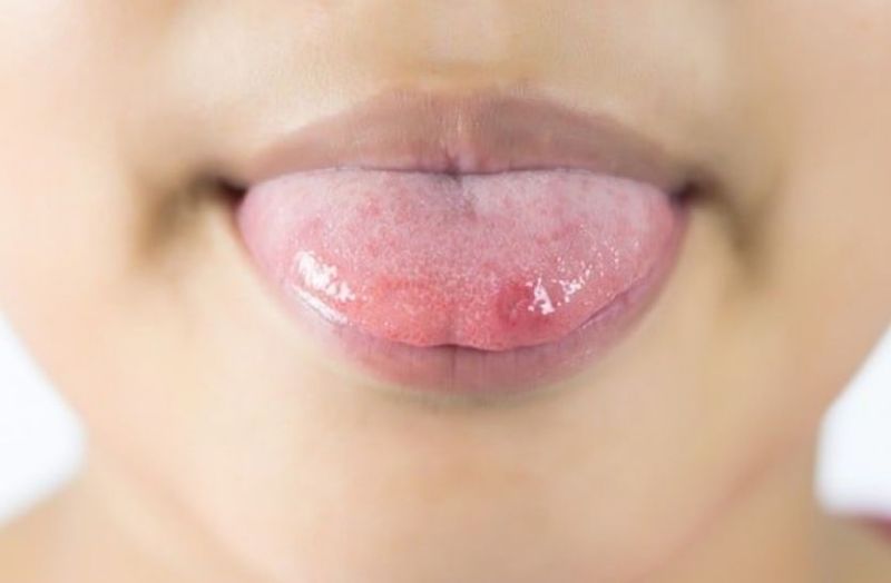 Tongue ulcers
