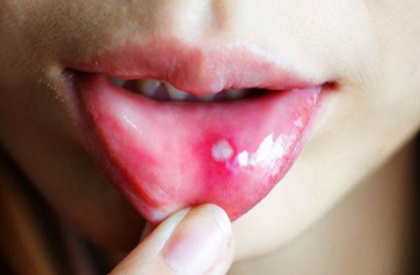 Mouth ulcers