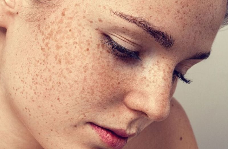 Freckles