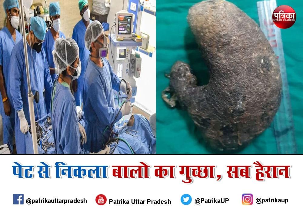 Trichobezoar disease:बालों को नोचकर खा जाती थी किशोरी, पेट से निकाला बालों का दो किलो का गुच्छा