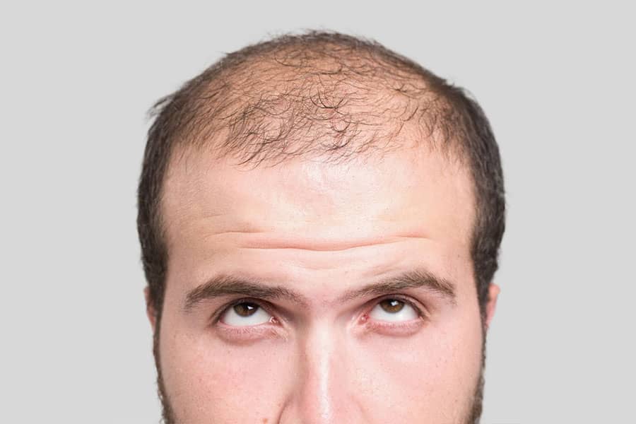 Natural Way to Reduce Hair Fall: बाल झड़ने से रोकने के लिए आजमाएं ये 5 प्राकृतिक
उपाय, गंजेपन से मिलेगा छुटकारा