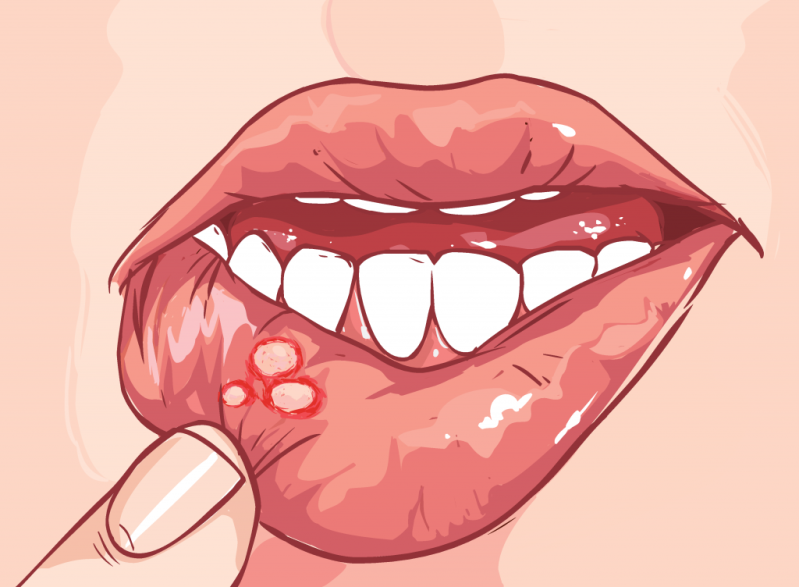mouth_ulcer.png