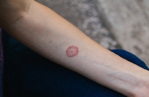 ringworm.jpg