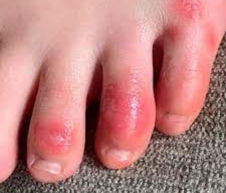 covid toe