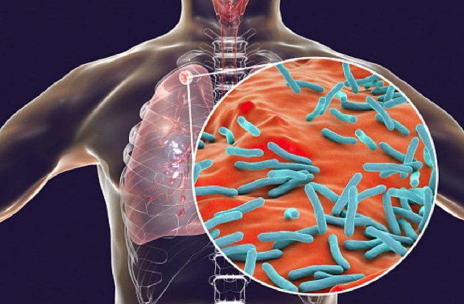 कोरोना ने रोकी टीबी के वायरस की रफ्तार, दो साल में मरीजों की संख्या में आई गिरावट