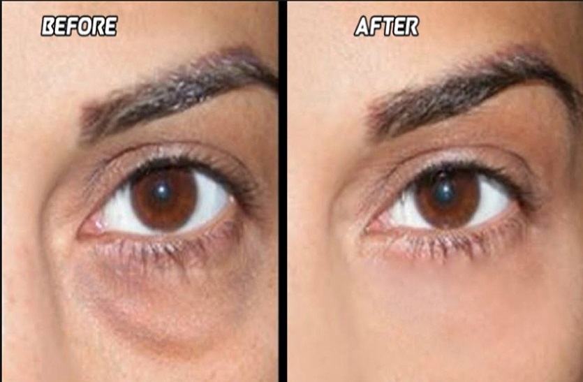 Home and natural remedies for Dark Circle: डार्क सर्कल्स दूर करने के घरेलू नुस्खे