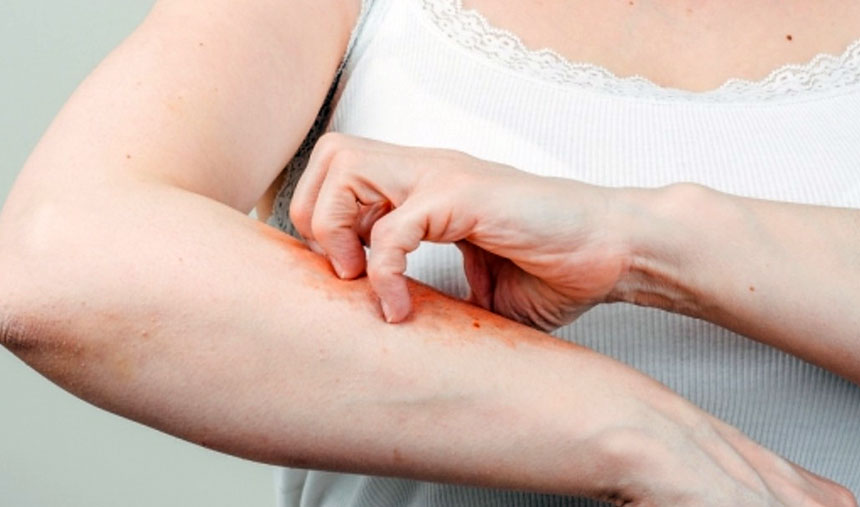 psoriasis_disease.jpg