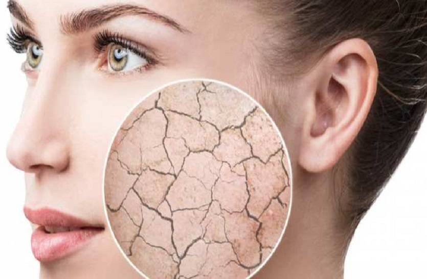 Dry Skin Treatment at Home : कैसे करें चेहरे का रूखापन दूर